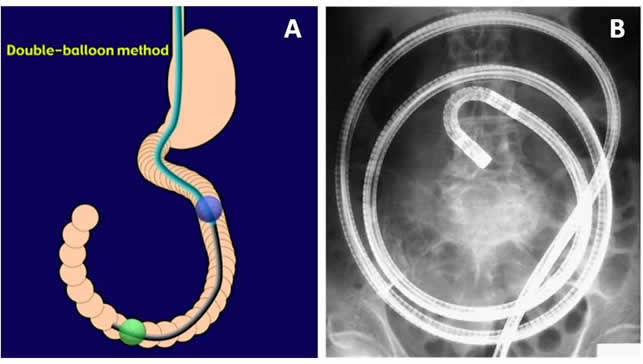 Educainflamatoria. Enfermedad Inflamatoria Intestinal Crohn Y Colitis ...