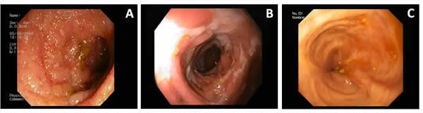 Imágenes endoscópicas de paciente con Enfermedad de Crohn