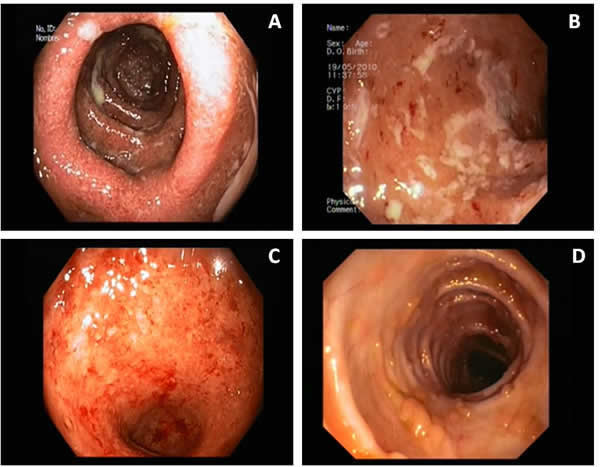 Imágenes endoscópicas de paciente con Colitis Ulcerosa