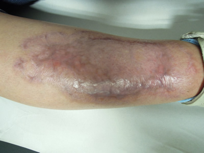 Imagen 2. Pioderma gangrenoso en pierna