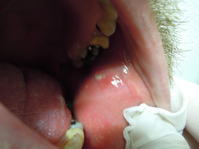 Imagen 3. Estomatitis aftosa en mucosa bucal revestimiento interno de la mejilla